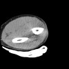 SPORK, NICO - 22.03.1976 - 02.08.2022 - CT obere Extremität - 17:56:57